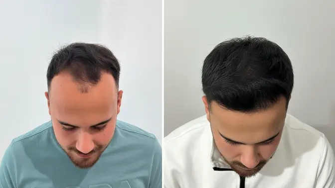 Before and after hair transplant result 10