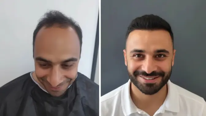 Before and after hair transplant result 14