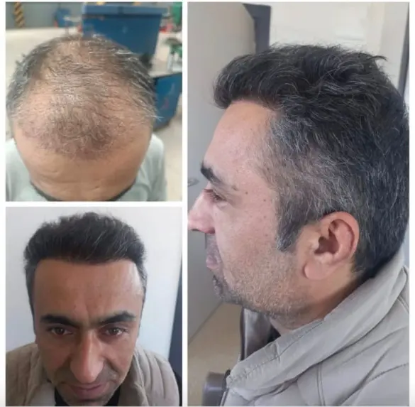 Before and after hair transplant result 16