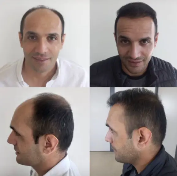 Before and after hair transplant result 17