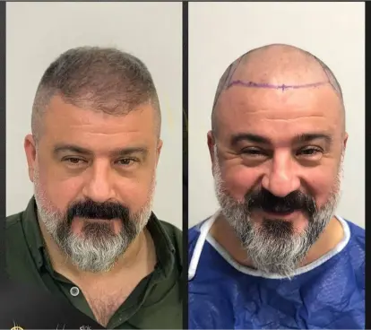 Seasonal hair care for transplanted hair