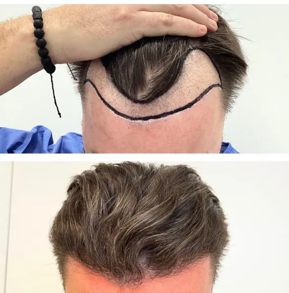 Before and after hair transplant result 21