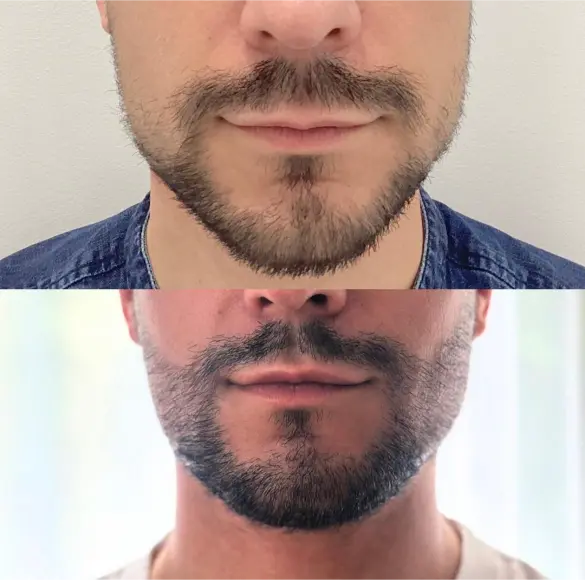 Before and after hair transplant result 22