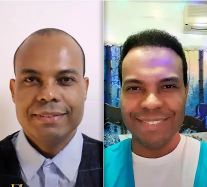 Before and after hair transplant result 19