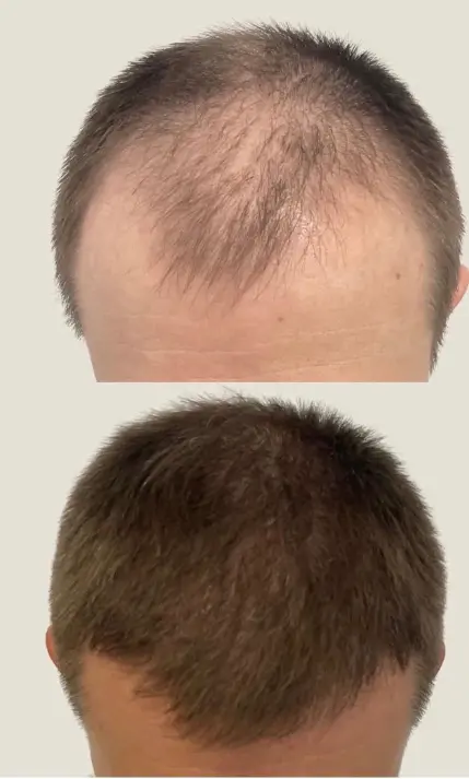 Before and after hair transplant result 23