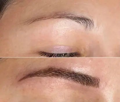 Before and after hair transplant result 24