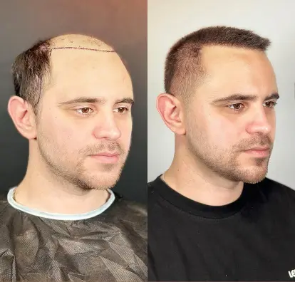 Avoiding common mistakes during hair transplant recovery process