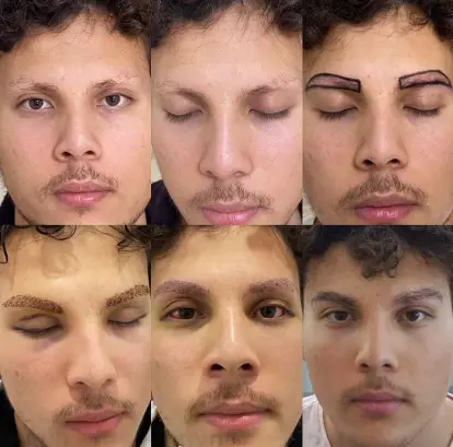 Successful hair transplant results after proper care