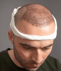 Hair Density Enhancement